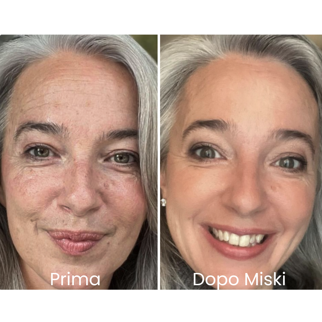 Miski Micro Infusion-System IT