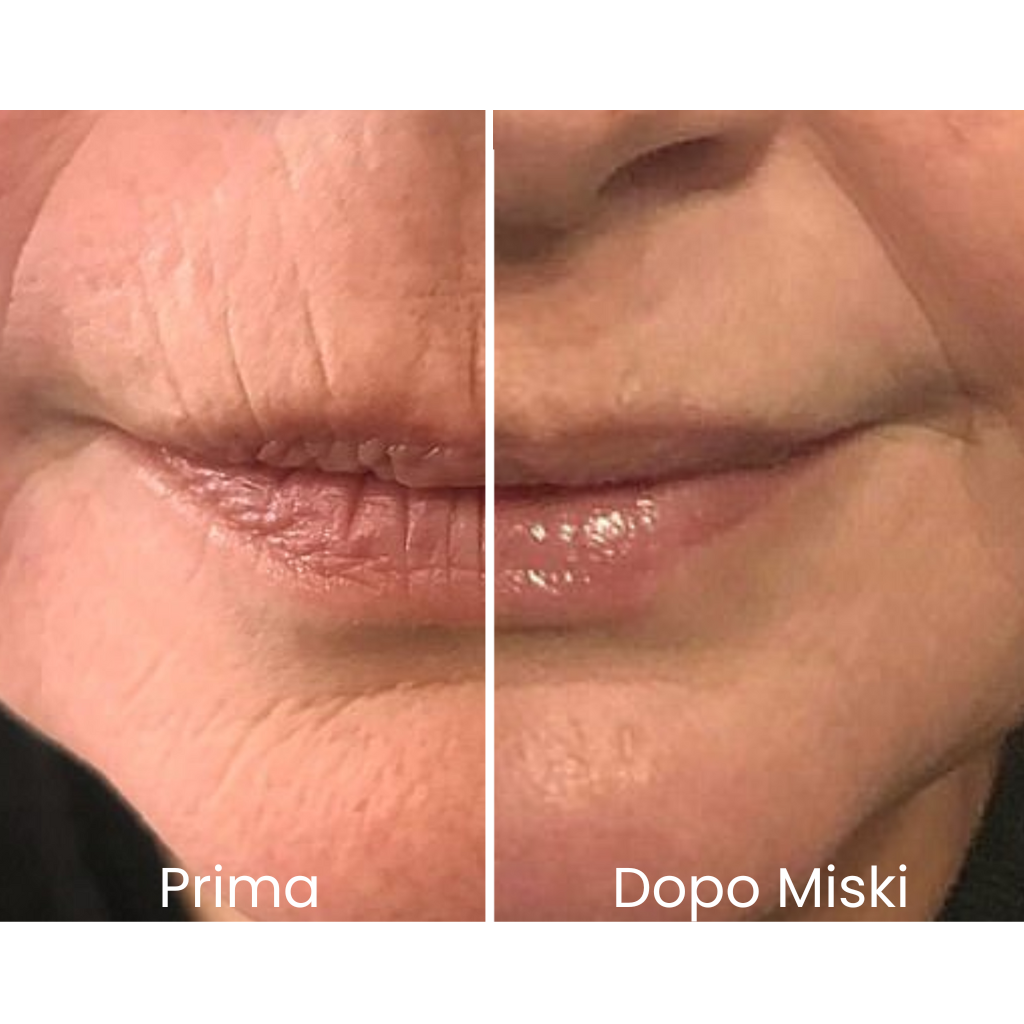 Miski Micro Infusion-System IT